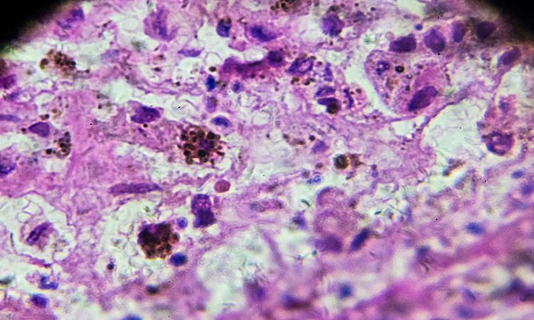 Estudio revela impacto de los genes heredados en el riesgo de melanoma