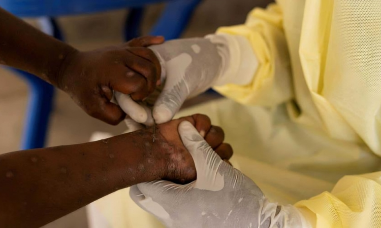 Salud Pública descarta viruela del mono en Azua: Confirman diagnóstico de herpes zóster (culebrilla)