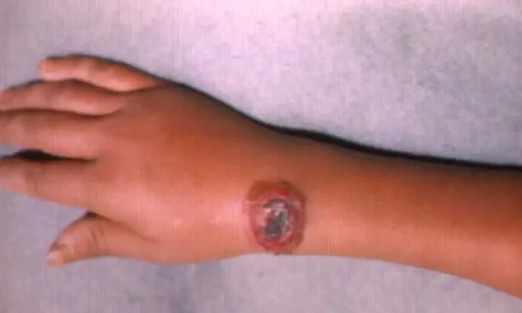 Sociedad de Dermatología pide reforzar vigilancia por brote de ántrax en Haití