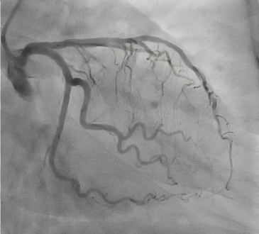 Angioplastia primaria es el tratamiento de elección en infartos según cardólogos intervencionistas