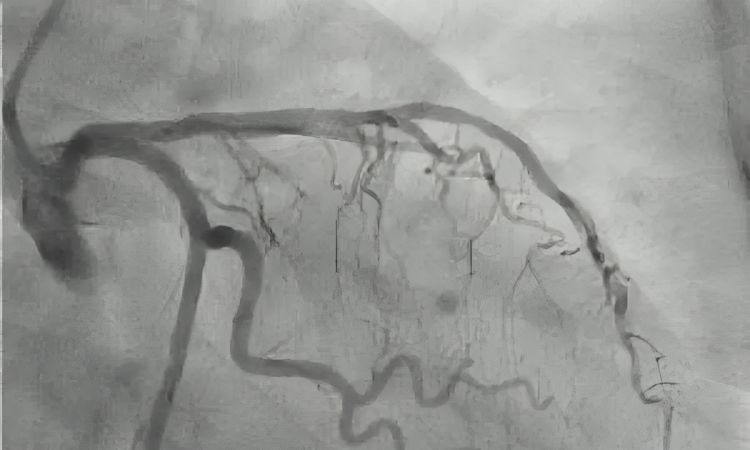 Angioplastia primaria es el tratamiento de elección en infartos según cardólogos intervencionistas
