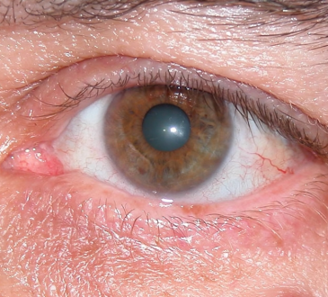 Expertos advierten sobre el glaucoma como “el ladrón silencioso de la visión” e instan a la prevención