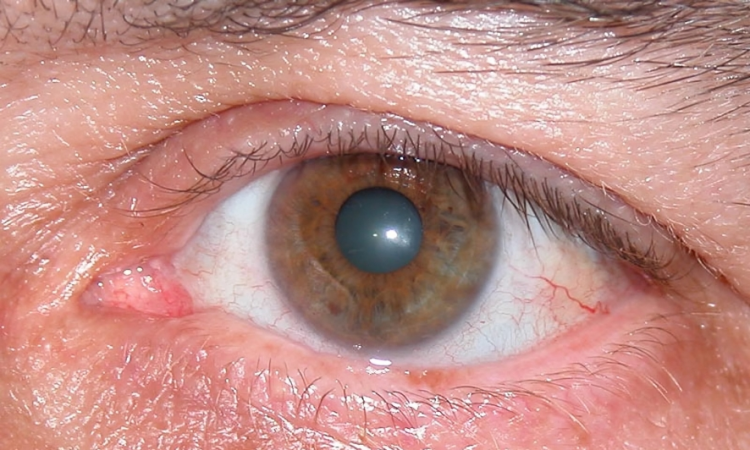 Expertos advierten sobre el glaucoma como “el ladrón silencioso de la visión” e instan a la prevención