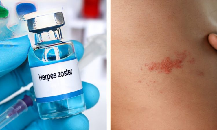 Vacuna contra el herpes zóster podría reducir riesgo cardiovascular hasta por ocho años, según estudio