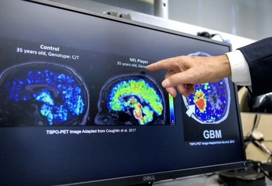 Científicos latinos descubren biomarcador que podría detectar Alzheimer décadas antes de los síntomas