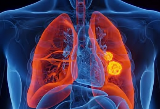 Científicos eliminan mutación clave del cáncer de pulmón con nueva herramienta genética