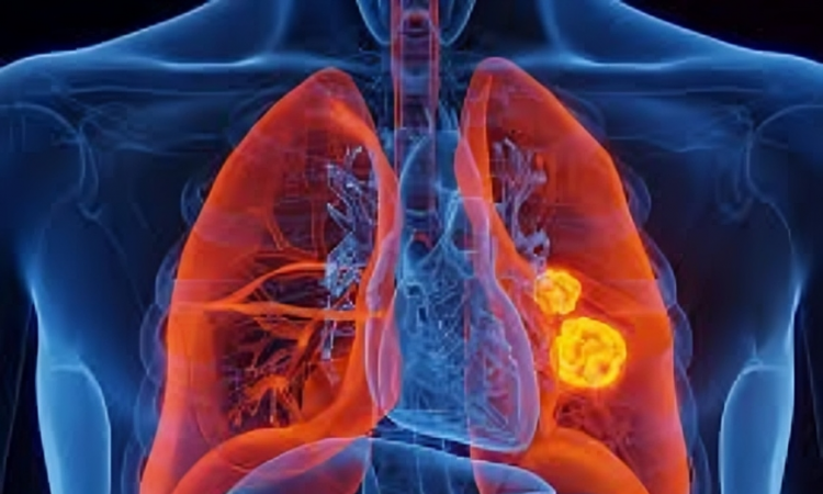 Científicos eliminan mutación clave del cáncer de pulmón con nueva herramienta genética