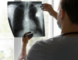 Estudio de Mayo Clinic revela que broncoscopia robótica mejora diagnóstico temprano del cáncer de pulmón con menor invasión