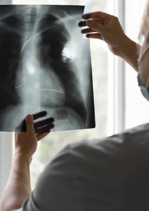 Estudio de Mayo Clinic revela que broncoscopia robótica mejora diagnóstico temprano del cáncer de pulmón con menor invasión