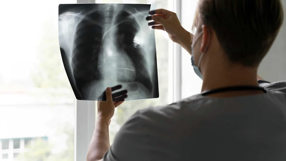 Estudio de Mayo Clinic revela que broncoscopia robótica mejora diagnóstico temprano del cáncer de pulmón con menor invasión